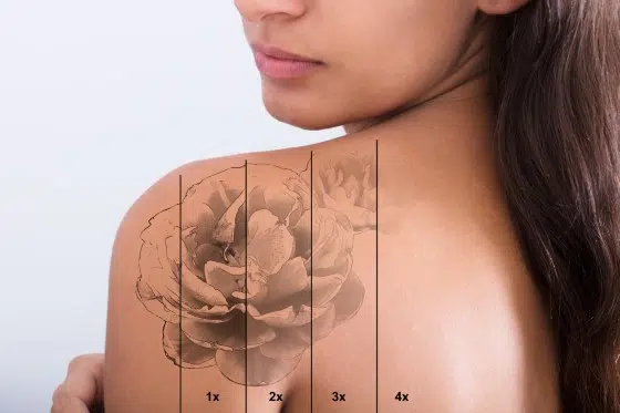 Choose Tattoo Removal