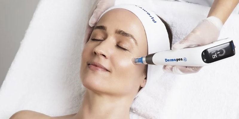Microneedling Treatment