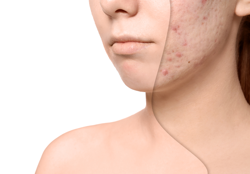 Acne Scar Reduction